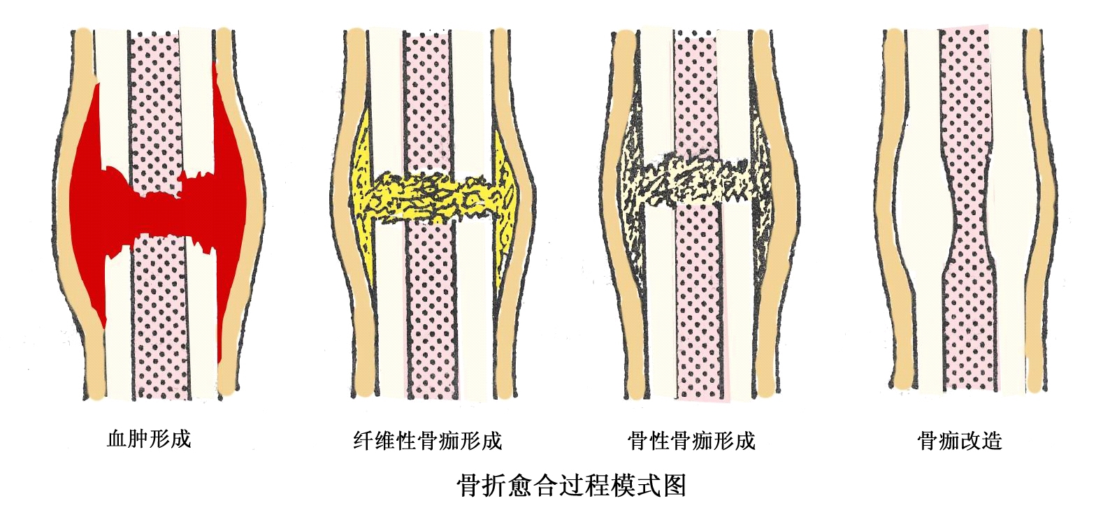 影响骨折愈合的因素